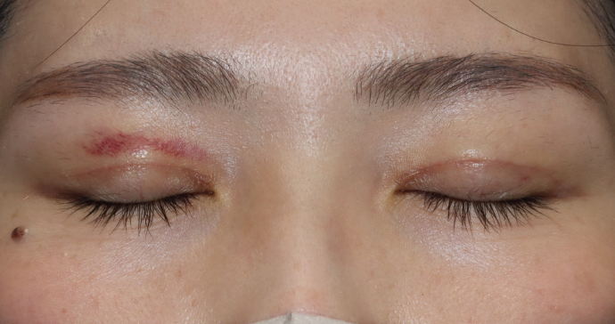 術後2週間 閉瞼の写真