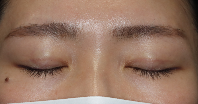 術後3ヵ月 閉瞼の写真