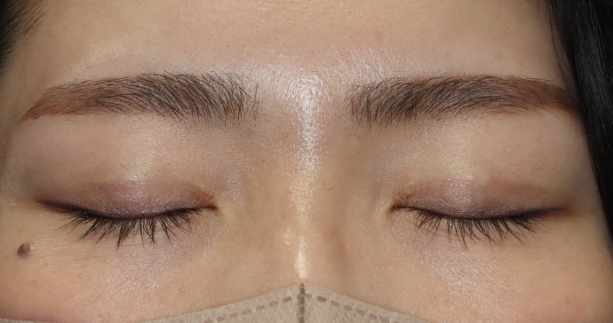 術後6ヵ月 閉瞼の写真