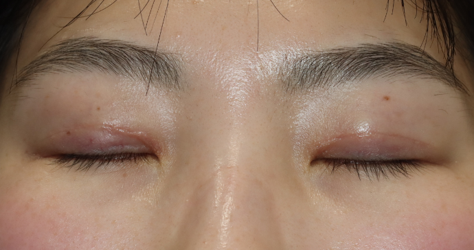 術後1ヵ月 閉瞼の写真