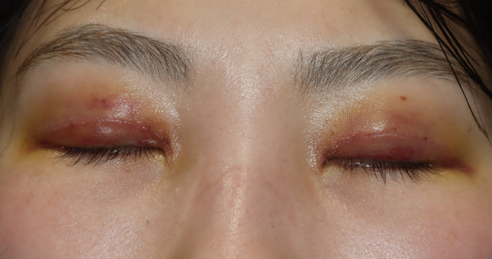 術後1週間 閉瞼の写真