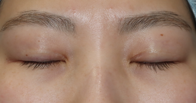 術前 閉瞼の写真