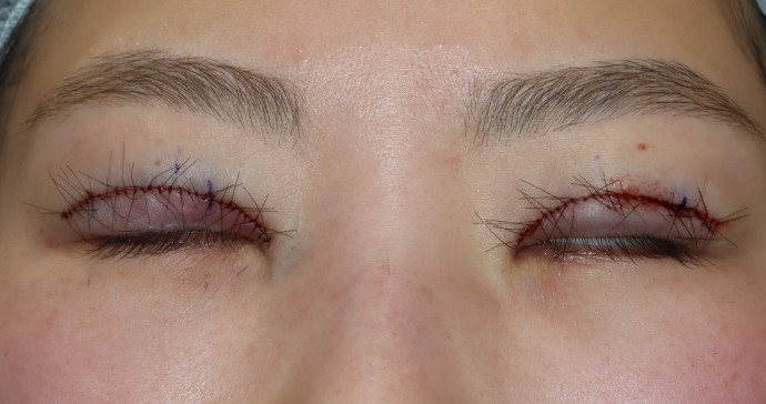 術直後 閉瞼の写真