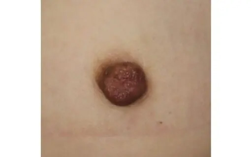 陥没乳頭再発の手術 術後