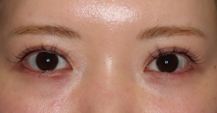 術後12ヵ月 写真