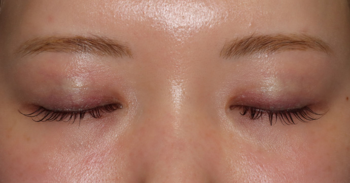 術後12ヵ月　閉瞼 写真