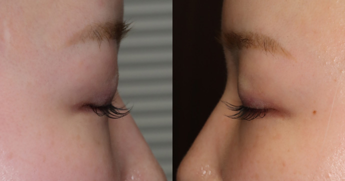 術後12ヵ月　横 写真