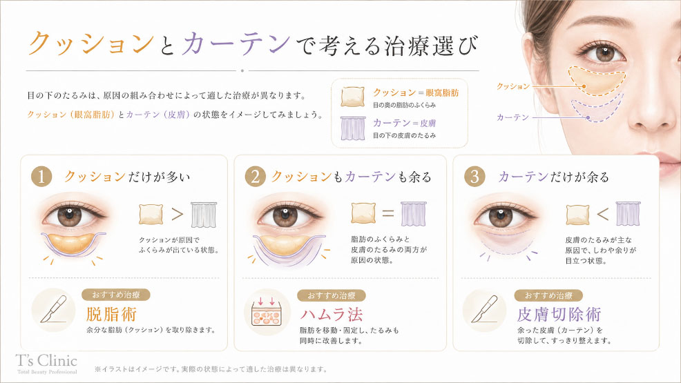 目の下のたるみ治療をクッションとカーテンの関係で説明する図
