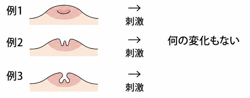 陥没乳頭重度
