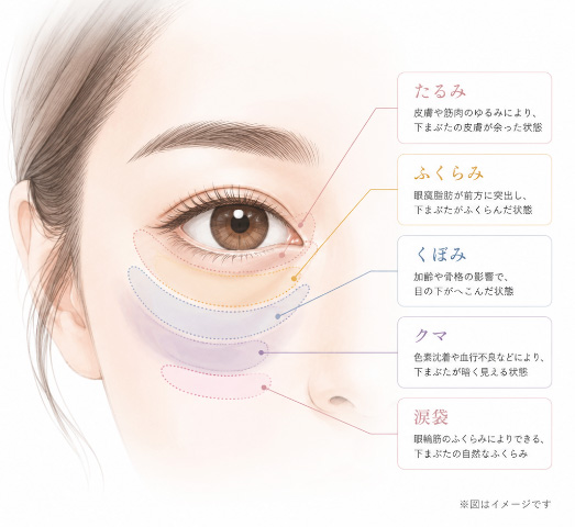 下まぶたのたるみ・ふくらみ・くぼみ・クマ・涙袋の位置を示す図