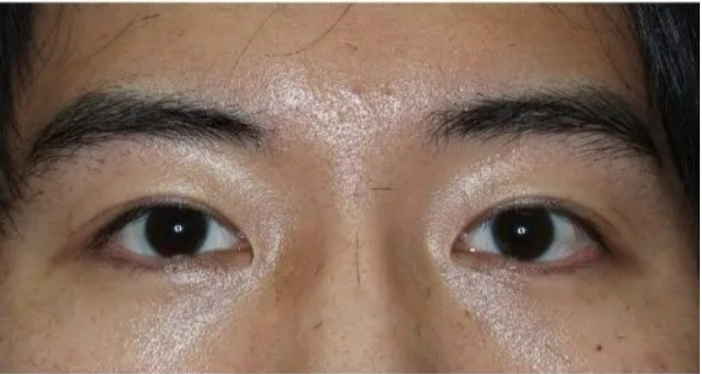 男性の一重まぶたに対する二重切開法 術後