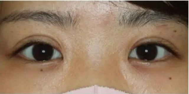 他院埋没法後の二重切開法(中間型ライン希望) 術後