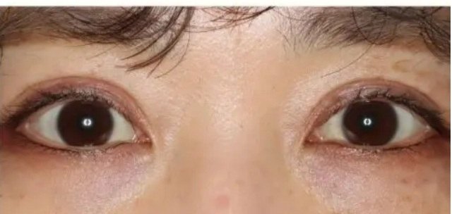 他院眼瞼下垂手術後の二重切開法による修正術 術後
