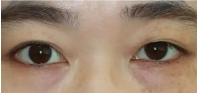 他院眼瞼下垂手術後の二重切開法による修正術 施術前