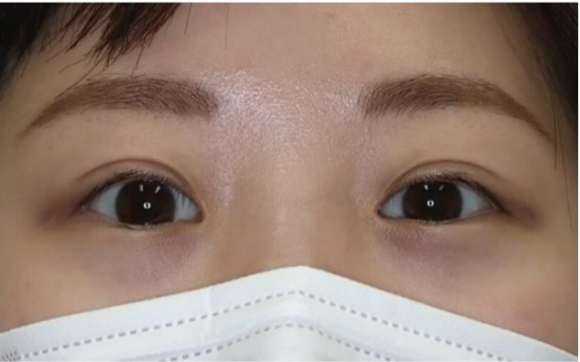 浅い二重から末広型二重を目指した二重切開法 術後